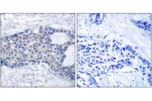 Immunohistochemistry analysis of paraffin-embedded human breast carcinoma, using ZAP-70 (Phospho-Tyr493) Antibody. (ZAP70 antibody  (pTyr493))