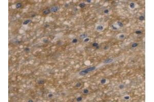 Detection of AQP4 in Human Glioma Tissue using Monoclonal Antibody to Aquaporin 4 (AQP4) (Aquaporin 4 antibody  (AA 178-317))