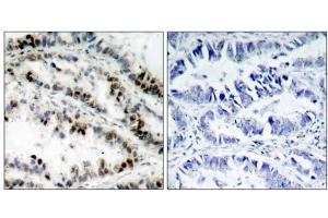 Immunohistochemical analysis of paraffin-embedded human lung carcinoma tissue using SMC1 (phospho-Ser957) antibody (E011198). (SMC1A antibody  (pSer957))