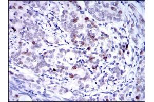 Immunohistochemical analysis of paraffin-embedded cervical cancer tissues using KID mouse mAb with DAB staining. (KIF22 antibody)