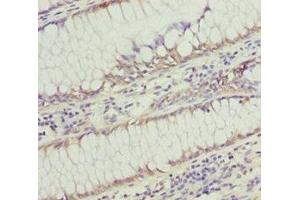 Immunohistochemistry of paraffin-embedded human colon cancer using ABIN7171004 at dilution of 1:100
