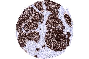 Pancreas Acinar cell carcinoma showing strong GP 2 immunostaining of all tumor cells (GP2 antibody  (AA 35-179))