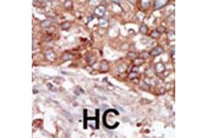 Formalin-fixed and paraffin-embedded human hepatocellular carcinoma tissue reacted with BLK polyclonal antibody  , which was peroxidase-conjugated to the secondary antibody, followed by AEC staining. (BLK antibody  (N-Term))