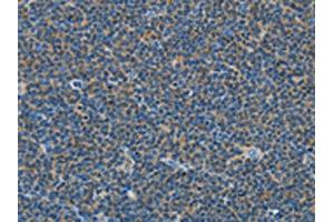 The image on the left is immunohistochemistry of paraffin-embedded Human lymphoma tissue using ABIN7129020(COX7B2 Antibody) at dilution 1/15, on the right is treated with fusion protein. (COX7B2 antibody)