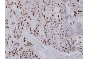IHC-P Image Immunohistochemical analysis of paraffin-embedded FaDu xenograft, using NULP1, antibody at 1:100 dilution.