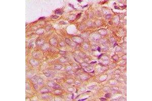 Immunohistochemical analysis of SPTBN1 staining in human breast cancer formalin fixed paraffin embedded tissue section. (SPTBN1 antibody)