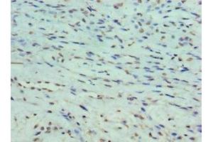 Immunohistochemistry of paraffin-embedded human breast cancer using ABIN7165931 at dilution of 1:100 (DARPP32 antibody  (Regulatory Subunit 1B))
