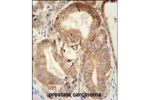 CLDN7 antibody (C-term) (ABIN654139 and ABIN2844008) immunohistochemistry analysis in formalin fixed and paraffin embedded human prostate carcinoma followed by peroxidase conjugation of the secondary antibody and DAB staining. (Claudin 7 antibody  (C-Term))