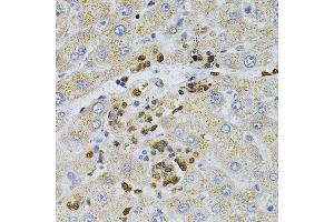 Immunohistochemistry of paraffin-embedded human liver injury using BEST1 antibody. (Bestrophin 1 antibody  (AA 200-300))