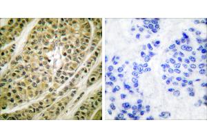 Peptide - +Immunohistochemical analysis of paraffin-embedded human breast carcinoma tissue using HDAC5 antibody (#C0225). (HDAC5 antibody)