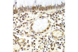 Immunohistochemistry of paraffin-embedded human gastric cancer using MCM4 Antibody (ABIN5971548) at dilution of 1/200 (40x lens). (MCM4 antibody)