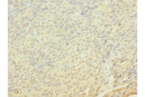 Immunohistochemistry of paraffin-embedded human cervical cancer using ABIN7152849 at dilution of 1:100 (FRS3 antibody  (AA 101-400))