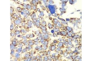 Immunohistochemistry of paraffin-embedded Human esophageal cancer using GLUD2 Polyclonal Antibody at dilution of 1:100 (40x lens).