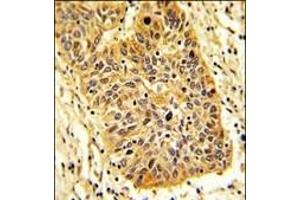 Formalin-fixed and paraffin-embedded human lung carcinoma reacted with RIOK1 Antibody (N-term), which was peroxidase-conjugated to the secondary antibody, followed by DAB staining.