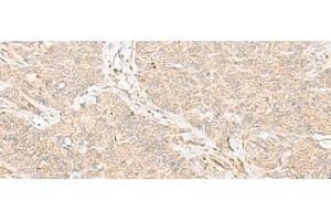 Immunohistochemistry of paraffin-embedded Human ovarian cancer tissue using TRAF6 Polyclonal Antibody at dilution of 1:30(x200) (TRAF6 antibody)