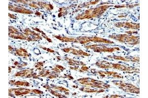 Formalin-fixed, paraffin-embedded human Leiomyosarcoma stained with SMMHC antibody (MYH11/923 + SMMS-1).