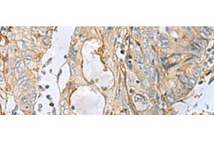 Immunohistochemistry of paraffin-embedded Human colorectal cancer tissue using MTHFD2 Polyclonal Antibody at dilution of 1:65(x200) (MTHFD2 antibody)