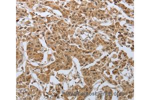 Immunohistochemistry of Human lung cancer using PSMD6 Polyclonal Antibody at dilution of 1:50 (PSMD6 antibody)