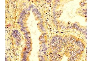 IHC image of ABIN7157495 diluted at 1:400 and staining in paraffin-embedded human colon cancer performed on a Leica BondTM system.