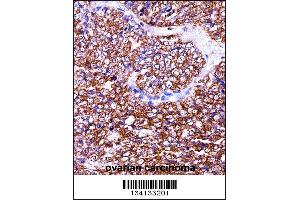 BAG2 Antibody immunohistochemistry analysis in formalin fixed and paraffin embedded human ovarian carcinoma followed by peroxidase conjugation of the secondary antibody and DAB staining. (BAG2 antibody  (C-Term))