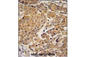 AWAT2 Antibody (C-term) (ABIN654780 and ABIN2844461) immunohistochemistry analysis in formalin fixed and paraffin embedded human skin carcinoma followed by peroxidase conjugation of the secondary antibody and DAB staining. (AWAT2 antibody  (C-Term))