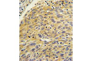 Formalin-fixed and paraffin-embedded human lung carcinoma with PLA2G4A Antibody (Center), which was peroxidase-conjugated to the secondary antibody, followed by DAB staining. (PLA2G4A antibody  (AA 513-541))