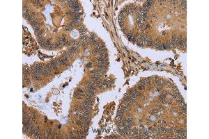 Immunohistochemistry of Human colon cancer using FHL2 Polyclonal Antibody at dilution of 1:50 (FHL2 antibody)