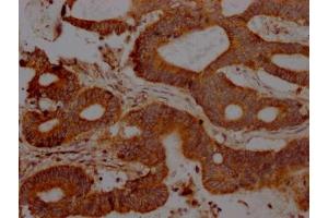 IHC image of ABIN7127483 diluted at 1:100 and staining in paraffin-embedded human colon cancer performed on a Leica BondTM system. (Recombinant FAS antibody)