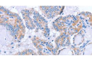 Immunohistochemistry of paraffin-embedded Human thyroid cancer tissue using FGF4 Polyclonal Antibody at dilution 1:40 (FGF4 antibody)