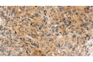 Immunohistochemistry of paraffin-embedded Human esophagus cancer using JNK2 Polyclonal Antibody at dilution of 1:30 (JNK2 antibody)