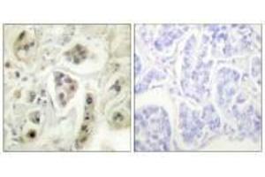 Immunohistochemical analysis of paraffin-embedded human lung carcinoma tissue using HSP60 antibody. (HSPD1 antibody)