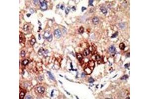 IHC analysis of FFPE human hepatocarcinoma tissue stained with the EZH2 antibody (EZH2 antibody)