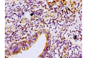 Immunohistochemistry of paraffin-embedded human lung cancer using ABIN7165698 at dilution of 1:100 (PKC beta antibody  (AA 517-643))