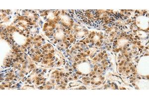 Immunohistochemistry of paraffin-embedded Human thyroid cancer using PDCD6 Polyclonal Antibody at dilution of 1:30 (PDCD6 antibody)