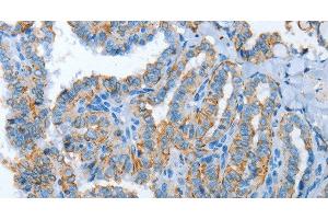 Immunohistochemistry of paraffin-embedded Human thyroid cancer tissue using ASL Polyclonal Antibody at dilution 1:35 (ASL antibody)