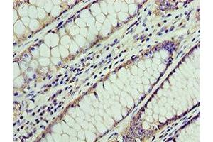 Immunohistochemistry of paraffin-embedded human colon cancer using ABIN7145038 at dilution of 1:100 (ATAD3A antibody  (AA 1-240))