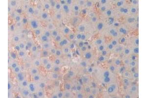 DAB staining on IHC-P; Samples: Human Liver cancer Tissue (ENPP1 antibody  (AA 625-780))