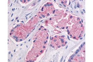 Anti-GPR87 antibody IHC of human Prostate, Carcinoma. (GPR87 antibody  (C-Term))