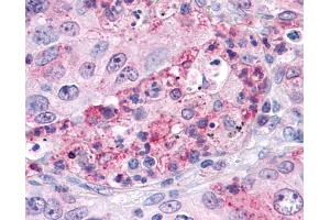 Anti-SGK3 antibody IHC of human Lung, Non-Small Cell Carcinoma. (SGK3 antibody  (Internal Region))