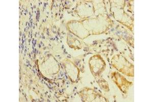 Immunohistochemistry of paraffin-embedded human gastric cancer using ABIN7157289 at dilution of 1:100 (KLHL26 antibody  (AA 366-615))