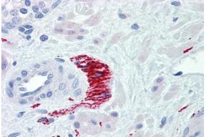 Human Prostate, Nerve (formalin-fixed, paraffin-embedded) stained with TH antibody ABIN462131 followed by biotinylated goat anti-rabbit IgG secondary antibody ABIN481713, alkaline phosphatase-streptavidin and chromogen. (Tyrosine Hydroxylase antibody)