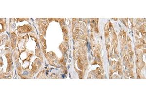 Immunohistochemistry of paraffin-embedded Human thyroid cancer tissue using PRNP Polyclonal Antibody at dilution of 1:45(x200) (PRNP antibody)