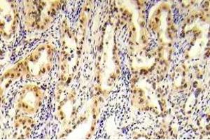Immunohistochemistry (IHC) analyzes of p-Tsc2 antibody in paraffin-embedded human prostate carcinoma tissue. (Tuberin antibody  (pSer1254))