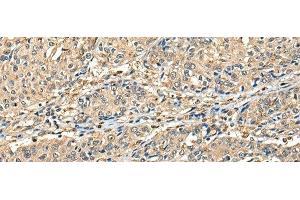 Immunohistochemistry of paraffin-embedded Human prost at e cancer tissue using CCDC112 Polyclonal Antibody at dilution of 1:45(x200) (CCDC112 antibody)