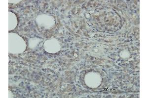 Immunoperoxidase of monoclonal antibody to PRDX2 on formalin-fixed paraffin-embedded human malignant lymphoma, diffuse large B tissue. (Peroxiredoxin 2 antibody  (AA 1-198))