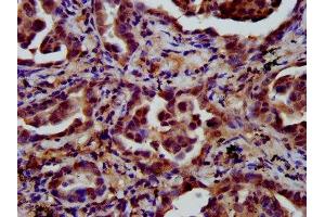 IHC image of ABIN7158226 diluted at 1:600 and staining in paraffin-embedded human lung cancer performed on a Leica BondTM system.