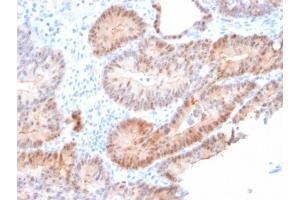 Formalin-fixed, paraffin-embedded human Prostate Carcinoma stained with AKR1C2 Mouse Monoclonal Antibody (CPTC-AKR1C2-1).