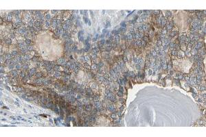 ABIN6274151 at 1/100 staining Human prostate tissue by IHC-P. (CKM antibody  (N-Term))