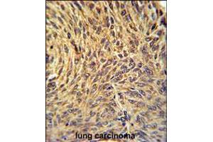 NUP210 Antibody immunohistochemistry analysis in formalin fixed and paraffin embedded human lung carcinoma followed by peroxidase conjugation of the secondary antibody and DAB staining. (NUP210 antibody  (N-Term))