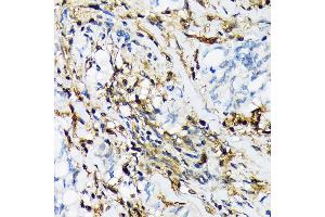 Immunohistochemistry of paraffin-embedded human lung cancer using PSMB9/LMP2 Rabbit mAb (ABIN7269596) at dilution of 1:100 (40x lens). (PSMB9 antibody)
